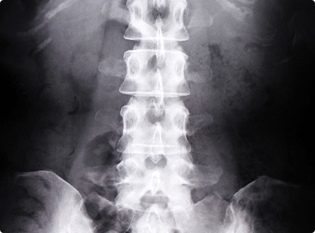 骨密度測定装置DEXA法